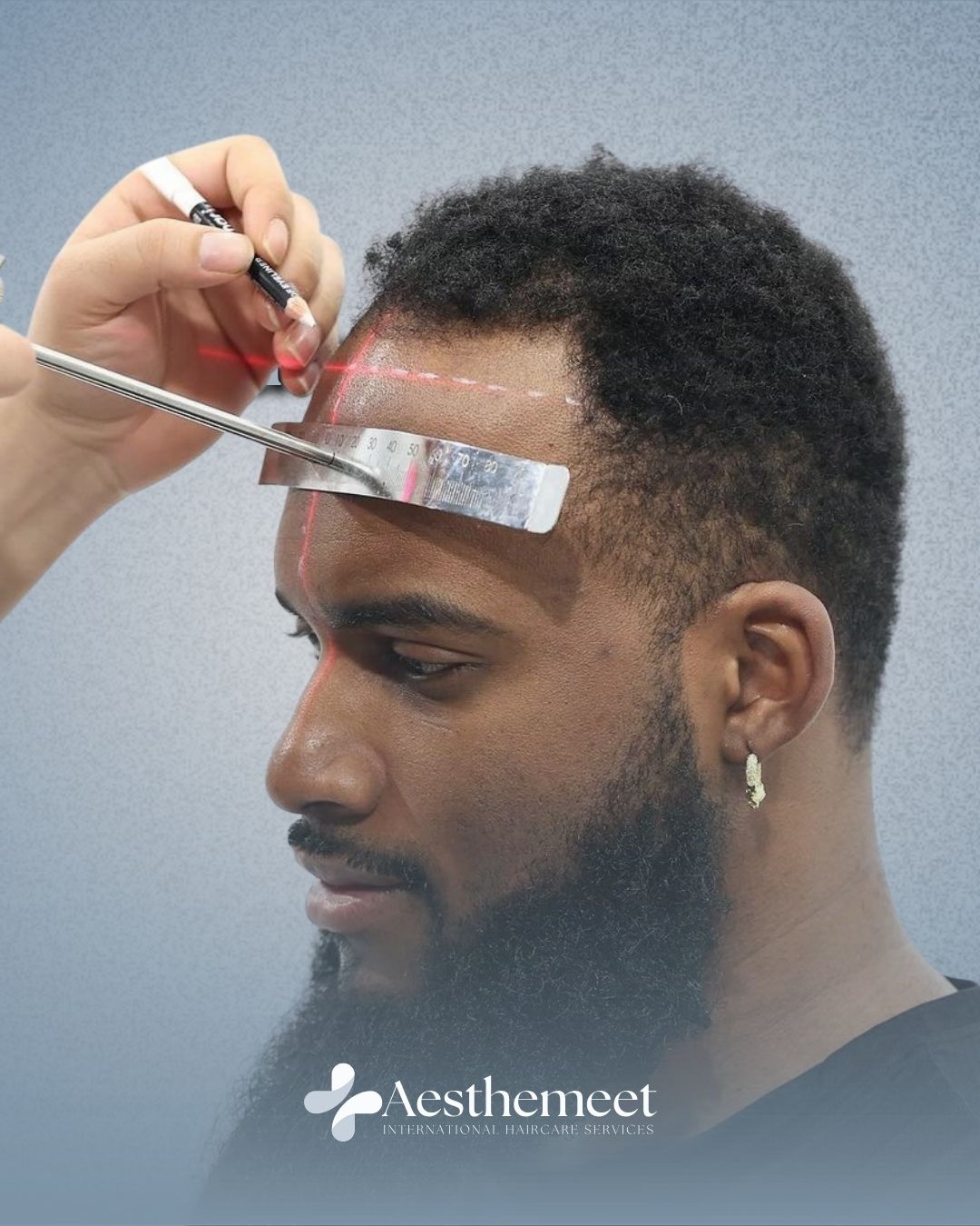 Natural hairline planning before hair transplant at Aesthemeet