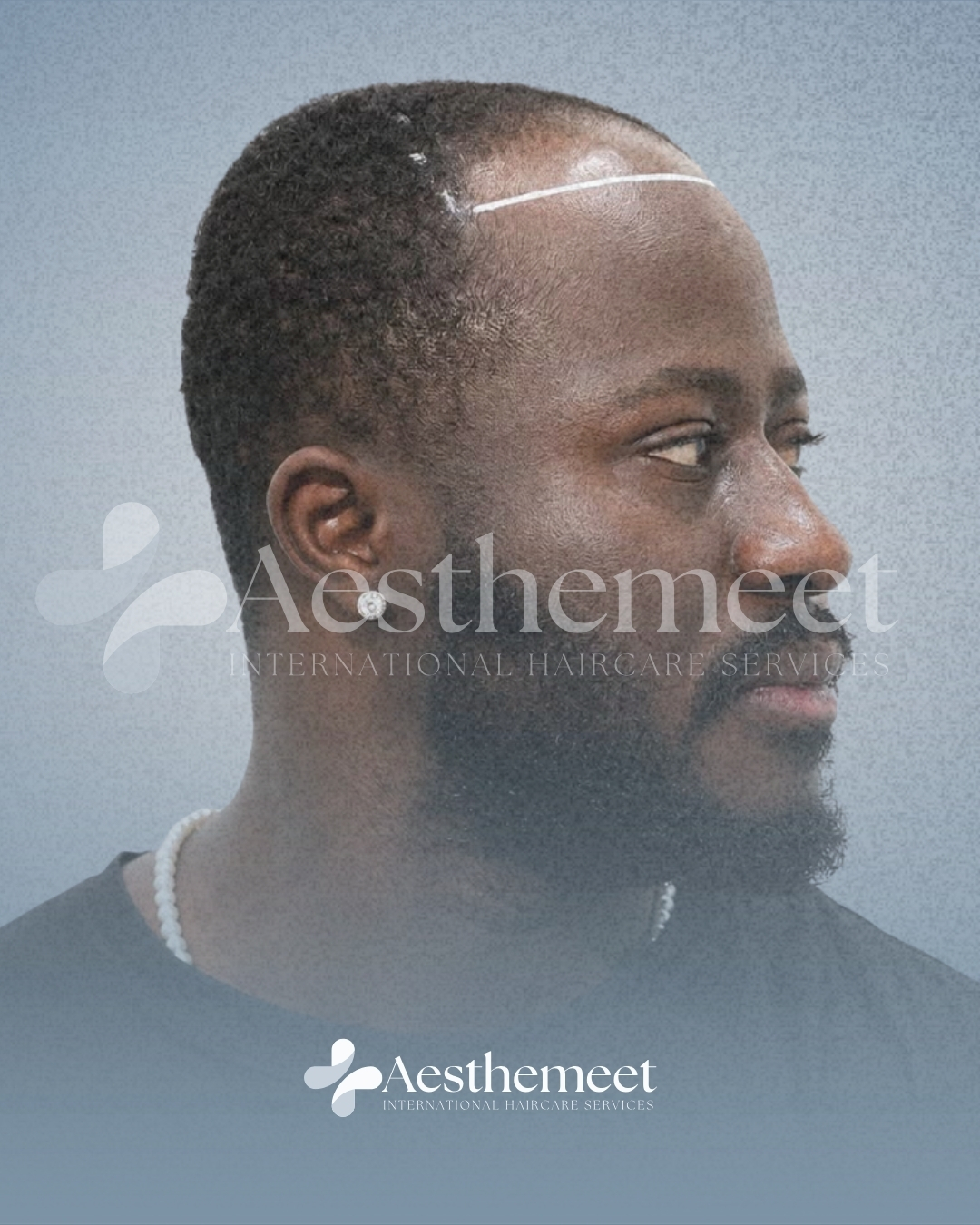 Patient 02 before Afro hair restoration