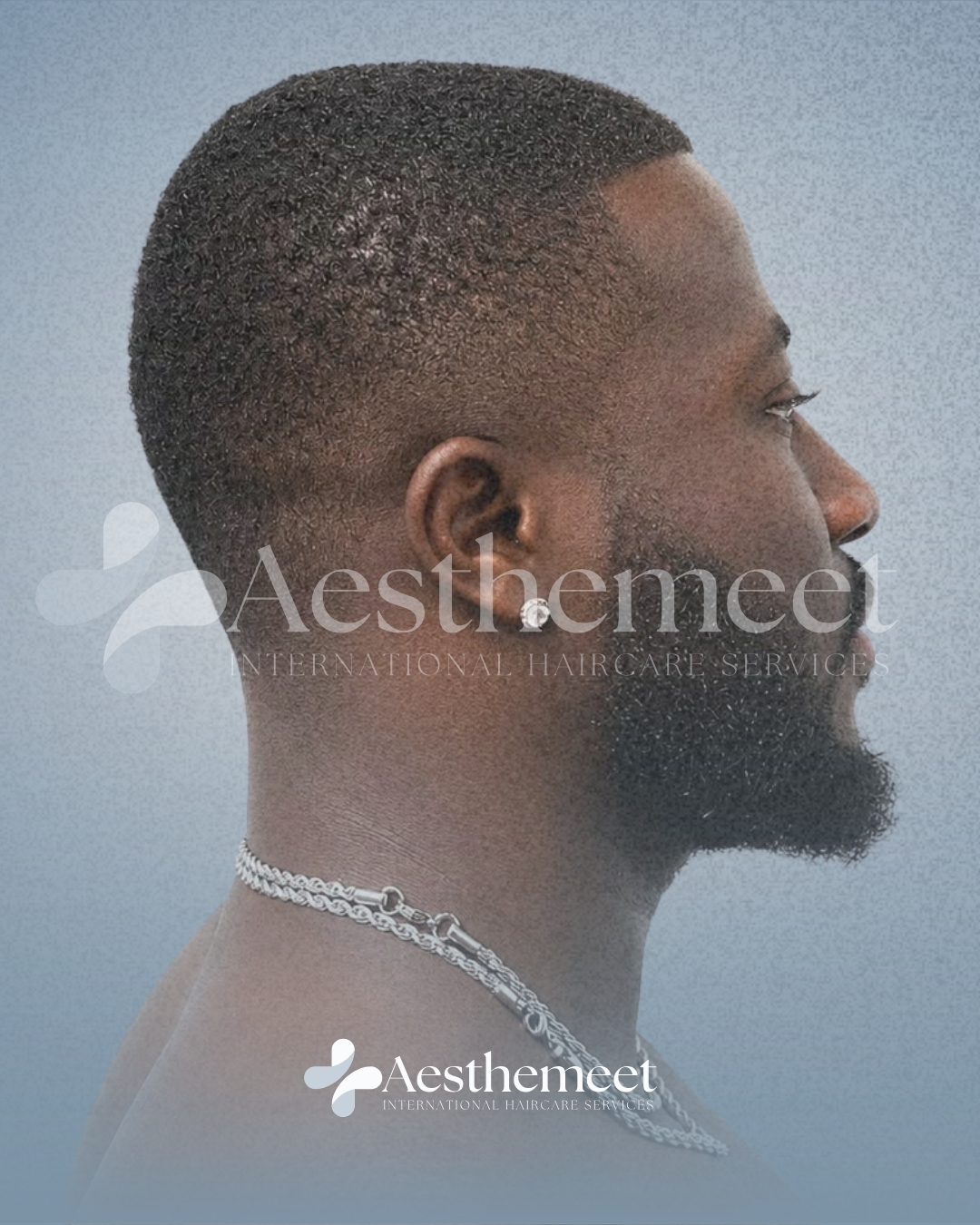 Patient 02 follow-up after Afro hair restoration