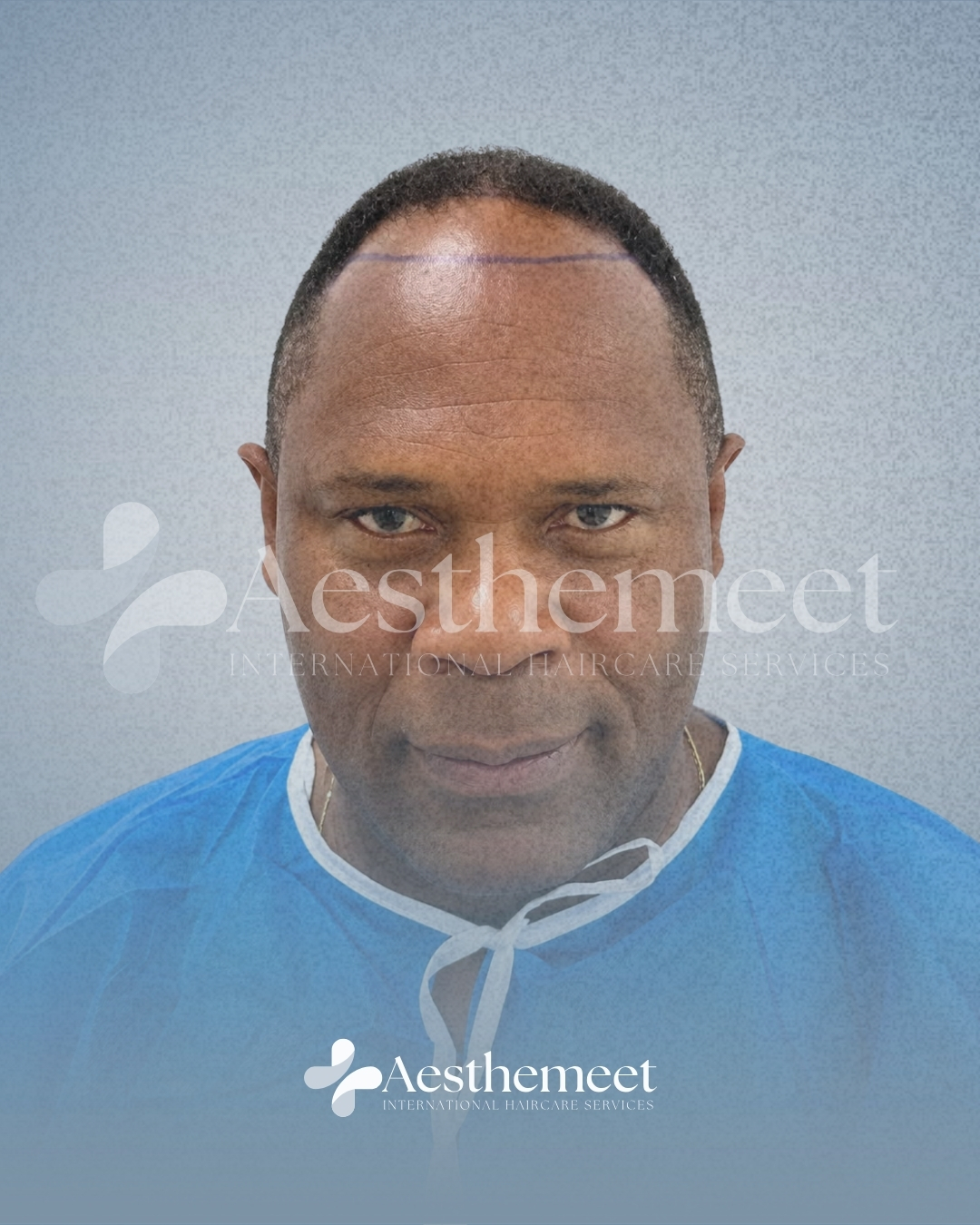 Patient 03 before front and mid-scalp hair restoration