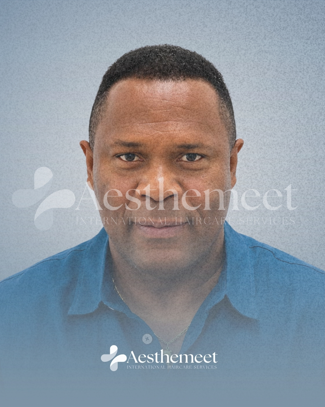 Patient 03 follow-up after front and mid-scalp hair restoration