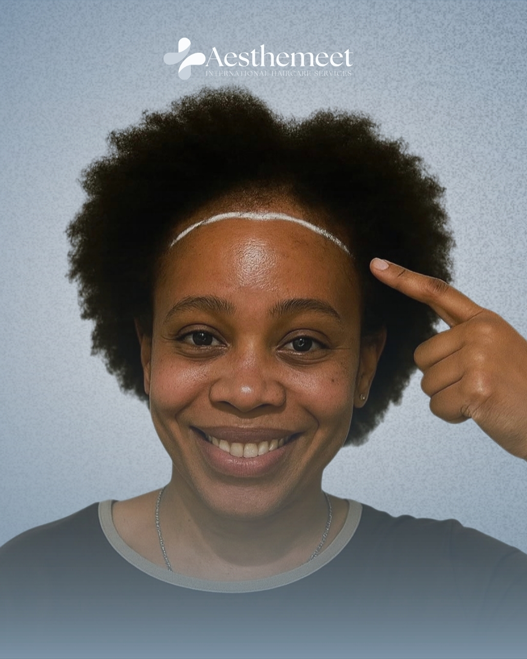 Afro hair transplant planning at Aesthemeet in Addis Ababa