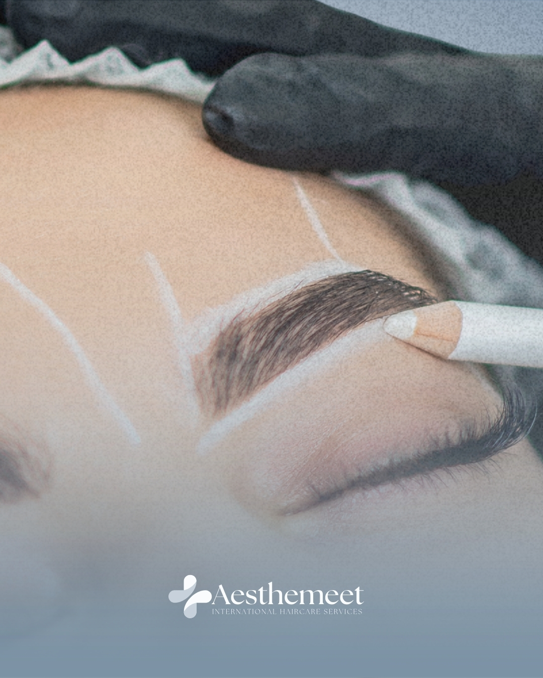 Eyebrow transplant treatment at Aesthemeet