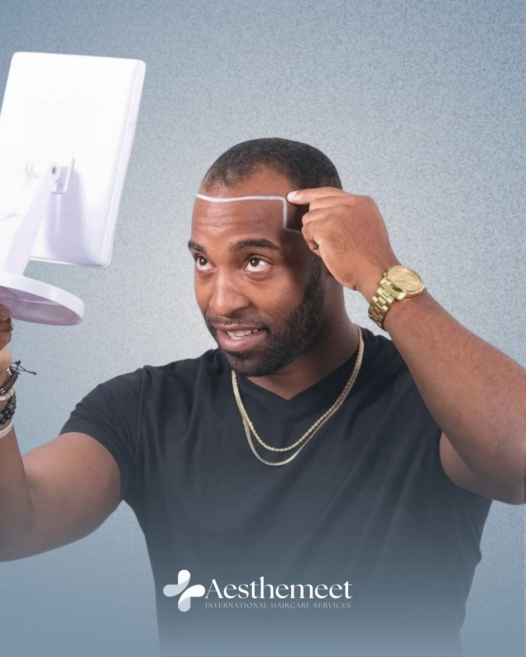 Hair transplant treatment planning at Aesthemeet in Addis Ababa