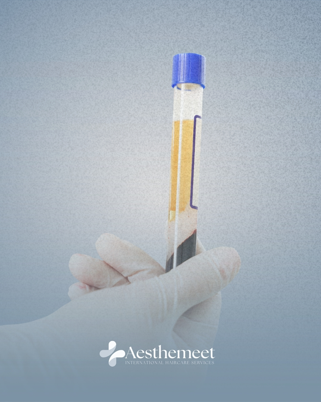 PRP hair treatment at Aesthemeet